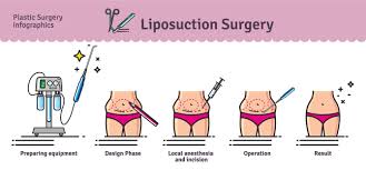 4 types methods of liposuction