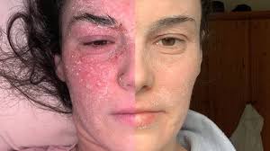 incredible eczema transformation