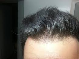 It is important to understand that after follicles are harvested and implanted into a thinning or balding area that these initial hairs fall out, for the most part, within two to three weeks. 7 Months In Fue And Can T See A Real Difference Follicular Unit Extraction Fue Hair Restoration Network Community For And By Hair Loss Patients