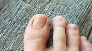 fungal nail infection cal channel