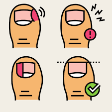 5 myths about ingrown toenails sol