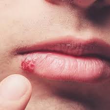 ᐅ do herpes cold sore home remes