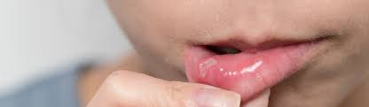 Haptō, deutsch ‚entfachen') ist eine schmerzhafte, von einem entzündlichen randsaum umgebene schädigung der schleimhaut des zahnfleischs, der mundhöhle einschließlich der lippen, der tonsillen oder der zunge. Aphten Im Mund Ursachen Behandlung Apotheke Sterzing