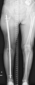 knee surgery