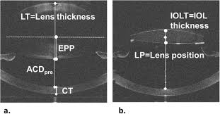 Estimation Of Intraocular Lens Position
