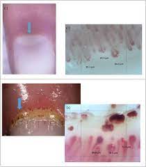 nailfold capillaroscopy