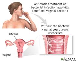 inal yeast infection information