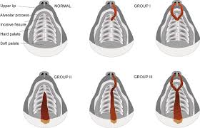 bilateral clefts