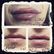 Lippen und nasolabialfalten aufbau mit hyaluronpen von noblesso. Crizia Nails Tolles Ergebnis Abgeheilte Lippen Nach 1 Facebook