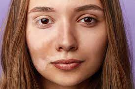 skin pigmentation disorders types