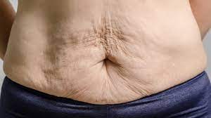 excess skin after weight loss