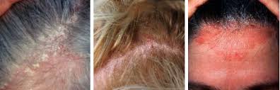 seborrheic dermais cause hair loss