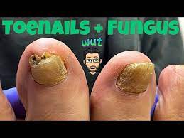 how to cut thick toenails with fungus
