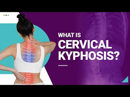 what s a reversal of cervical lordosis