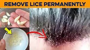 home remes to get rid of lice eggs