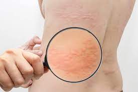 how to cure urticaria naturally