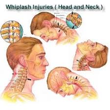 Being in a car crash can be stressful, but everyone should have an accident procedure in the case that they are involved in one. Whiplash Turning Point Chiropractic Saratoga Springs Ny Chiropractor