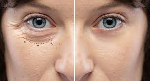 cosmetic plastic surgery multack eye care