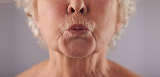 upper lip smoker s lines with botox