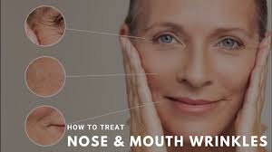 how to treat nose mouth wrinkles