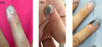 nail bed and flap reconstructions for