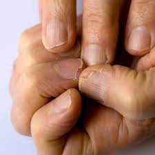how to repair brittle breaking nails by