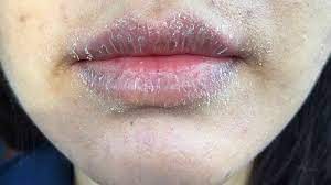 lip allergy cause symptoms treatment
