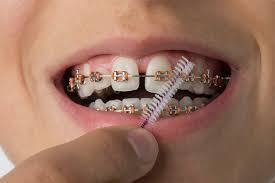 It is common for the buckteeth and the upper jaw bone to move forward and as a result the spaces between the teeth get larger and larger. Gap Teeth What Causes Gaps Between Front Teeth How To Fix It Cost Dentaleh