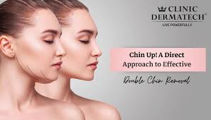 double chin removal