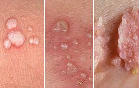 warts causes signs