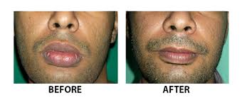 lip reduction surgery in la stan