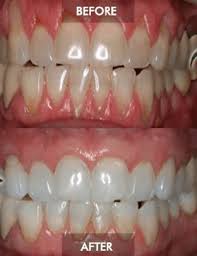 gum graft in mexico correction of