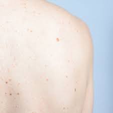 Do More Moles Mean More Problems Not So Says New Study