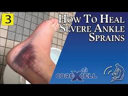 severe ankle sprain healed rapidly