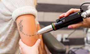 orlando tattoo removal deals in and