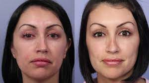 Is there any way i could get my insurance to cover both? Septoplasty Los Angeles Nose Reshaping By Dr David Stoker