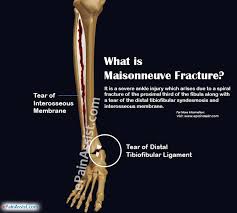 Maisonneuve fracture (mf) is a generally known entity in ankle trauma. Maisonneuve Fracture Causes Symptoms Treatment Recovery Period