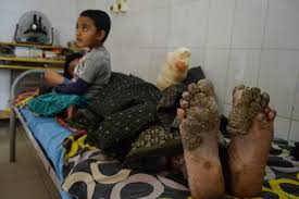 The topic tree man syndrome you are seeking is a synonym, or alternative name, or is closely related to the medical condition epidermodysplasia verruciformis. After 24 Surgeries Bangladesh Tree Man Relapses