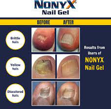 nonyx nail gel a toenail fungus