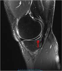 al meniscus tear knee specialist