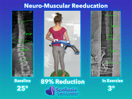 scoliosis exercises to improve posture