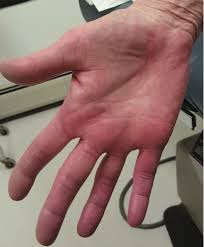The erythema is unrelated to temperature or exercise. Unilateral Palmar Erythema A Sequela Of Thoracic Outlet Syndrome The Dermatologist