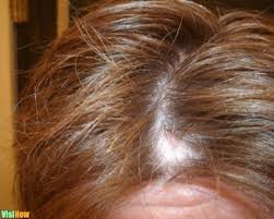 Side effects of chemotherapy or radiation therapy. Stop And Reverse Hair Loss In Women Caused By Low Iron Levels Vs Underactive Thyroid Vs Insulin Resistance And Inflammation Visihow
