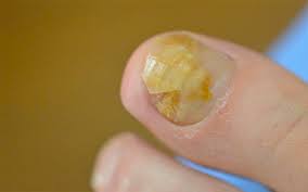 We did not find results for: Toenail Fungus Diabetes Is Toenail Fungus A Sign Of Diabetes