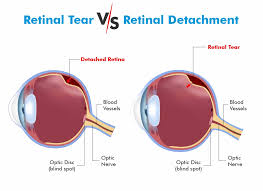 retinal tear vs retinal detachment