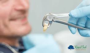 5 essential tips for tooth extraction