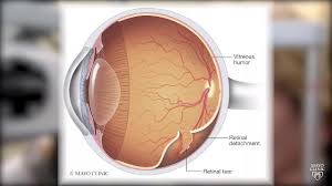 Retinal Detachment Symptoms And Causes Mayo Clinic
