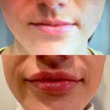 lip enhancement fillers botox in