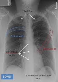 Abcde aproach the anatomy of the heart can appear artificially larger due to this image orientation. Anatomy Of Chest X Ray X Ray Radiology Radiography