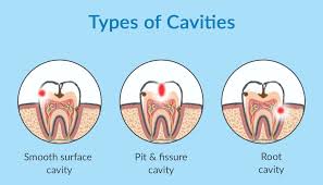 8 myths about cavities explained